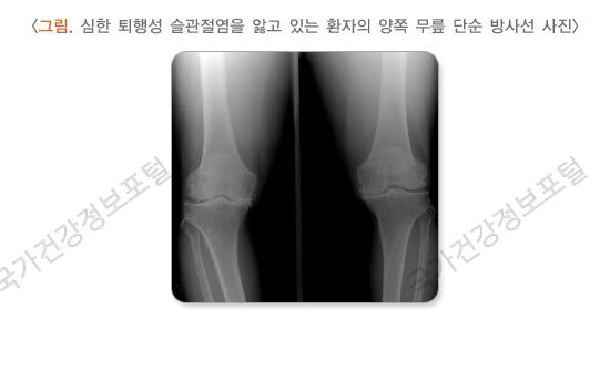 심한 퇴행성 슬관절염을 앓고 있는 환자의 양쪽 무릎 단순 방사선 사진