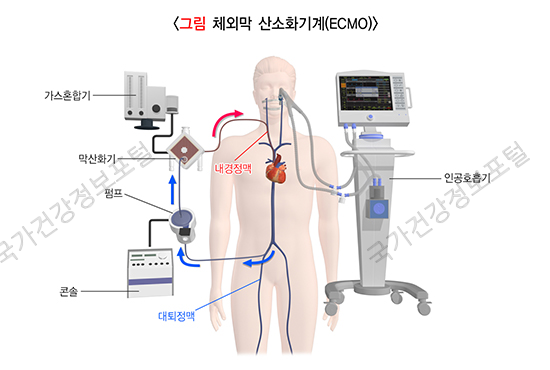 s12_R00_032_i03_체외막 산소화기계(ECMO)-비약물 치료