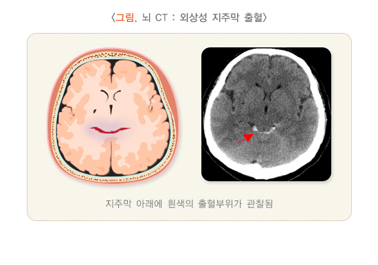 외상성 지주막 출혈의 뇌 CT 사진-종류