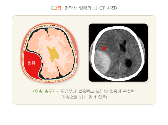 경막상 혈종의 뇌 CT 사진-종류