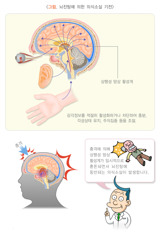 뇌진탕에 의한 의식 소실 기전-종류