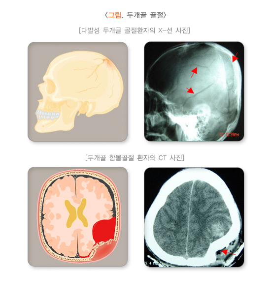 두개골 골절-종류