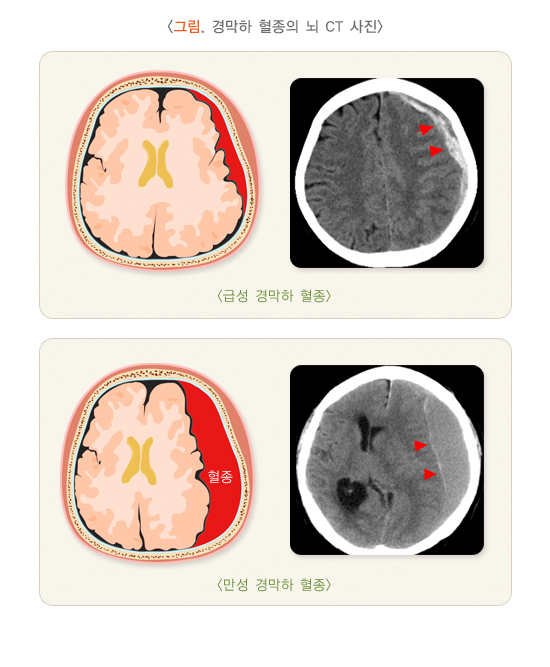 경막하 혈종의 뇌 CT 사진-종류