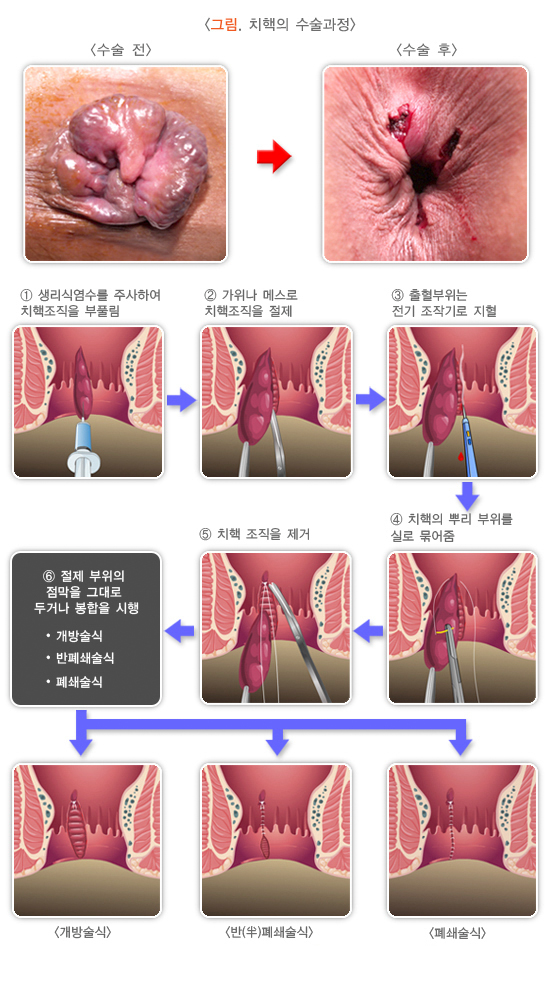 치핵의 수술과정