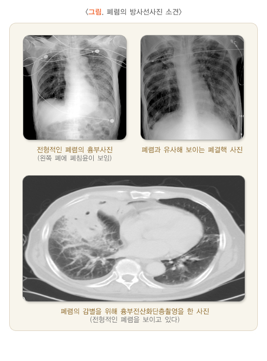 폐렴의 방사선사진 소견