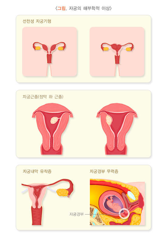자궁의 해부학적 이상