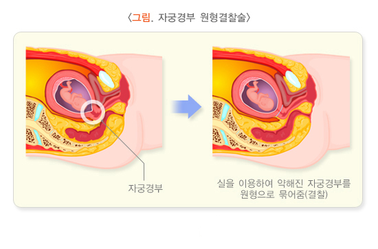 자궁경부 원형결찰술