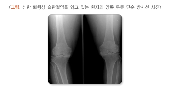 심한 퇴행성 슬관절염을 앓고 있는 환자의 양쪽 무릎 단순 방사선 사진