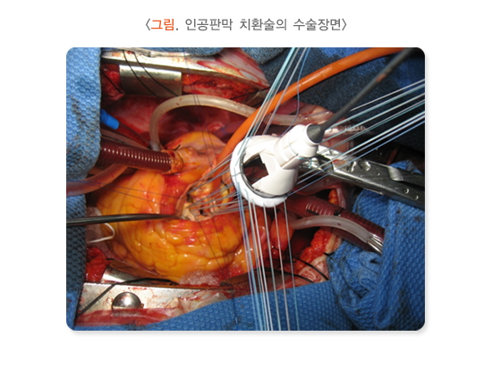 인공판막 치환술의 수술장면