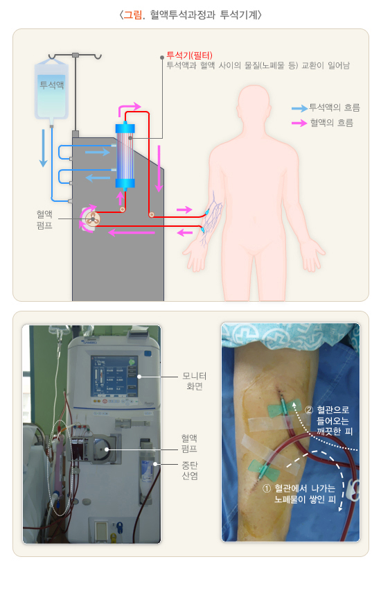 혈액투석과정과 투석기계