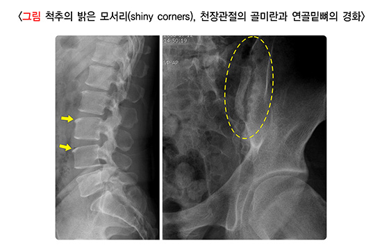 척추의 밝은 모서리(shiny corners), 천장관절의 골미란과 연골밑뼈의 경화