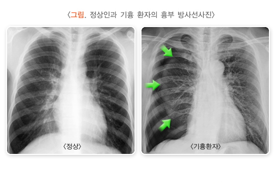 정상인과 기흉 환자의 흉부 방사선사진